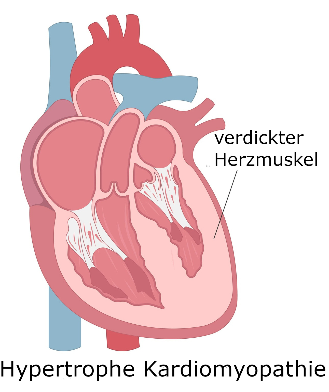 Grafik Hypertrophe Herzmuskelerkrankung