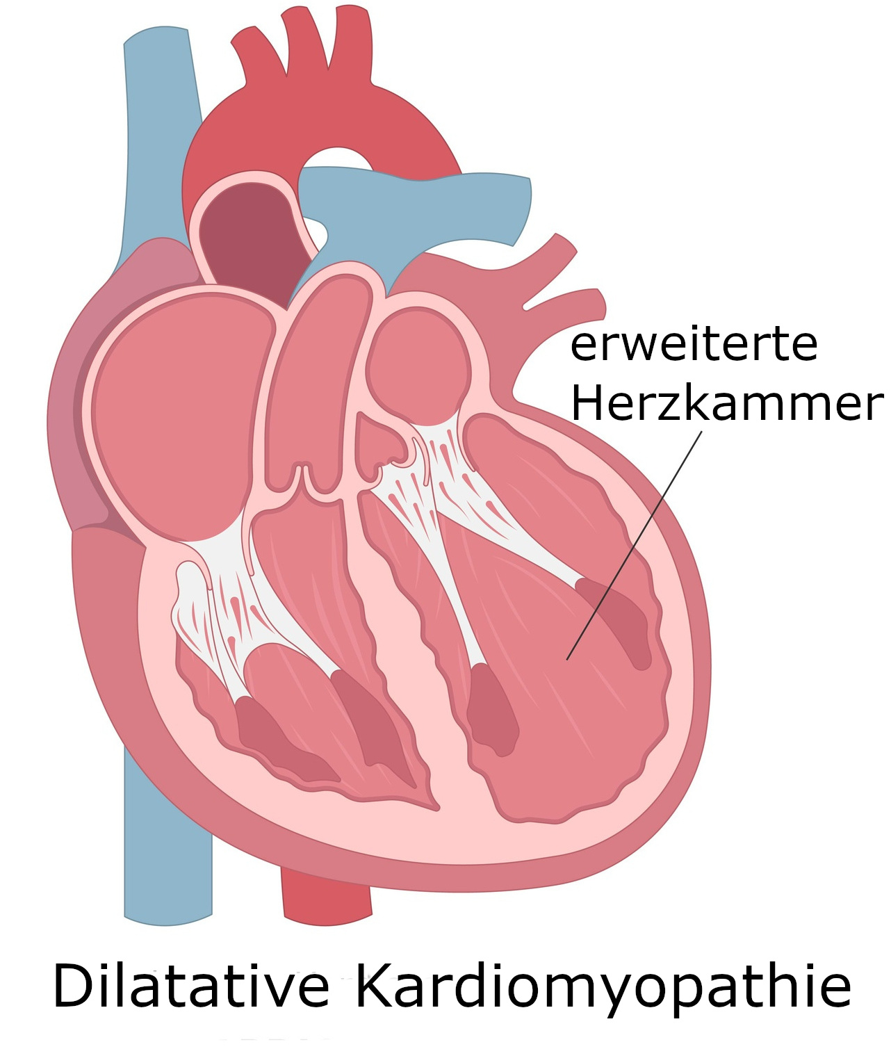Grafik Dilatative Herzmuskelerkrankung