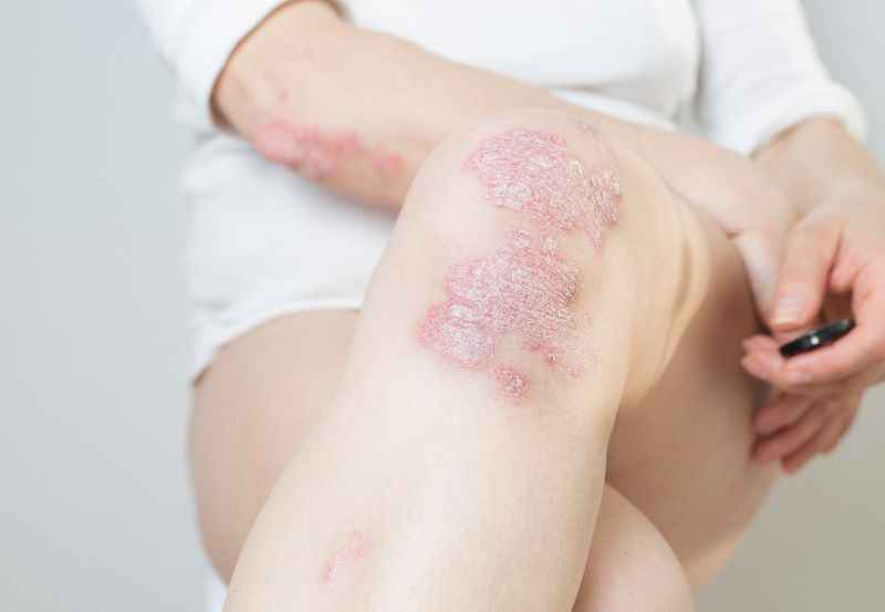 Frau mit Psoriasis auf den Knien und dem Ellbogen