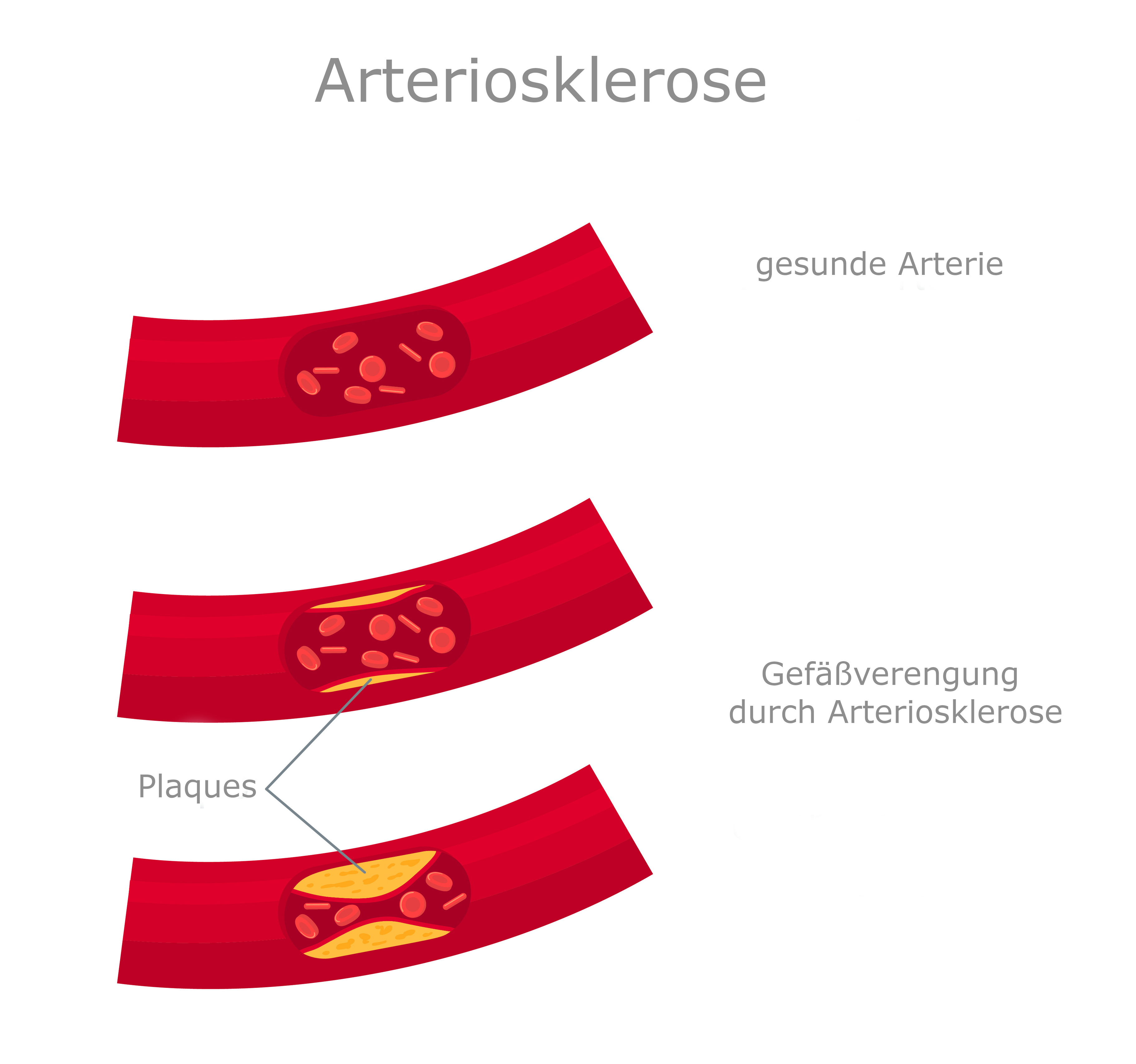 Symbolbild Arteriosklerose