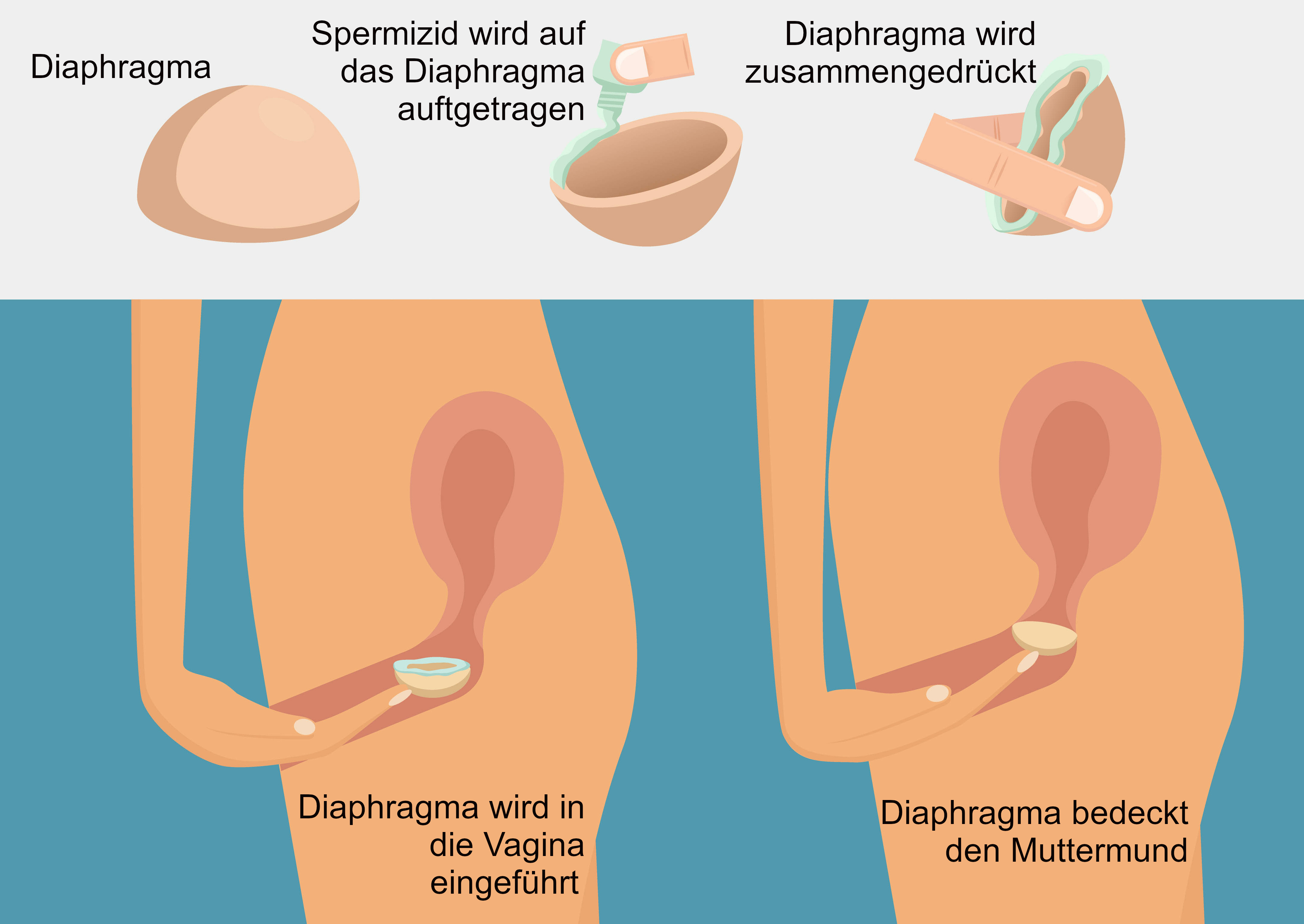 Grafik Anwendung Diaphragma