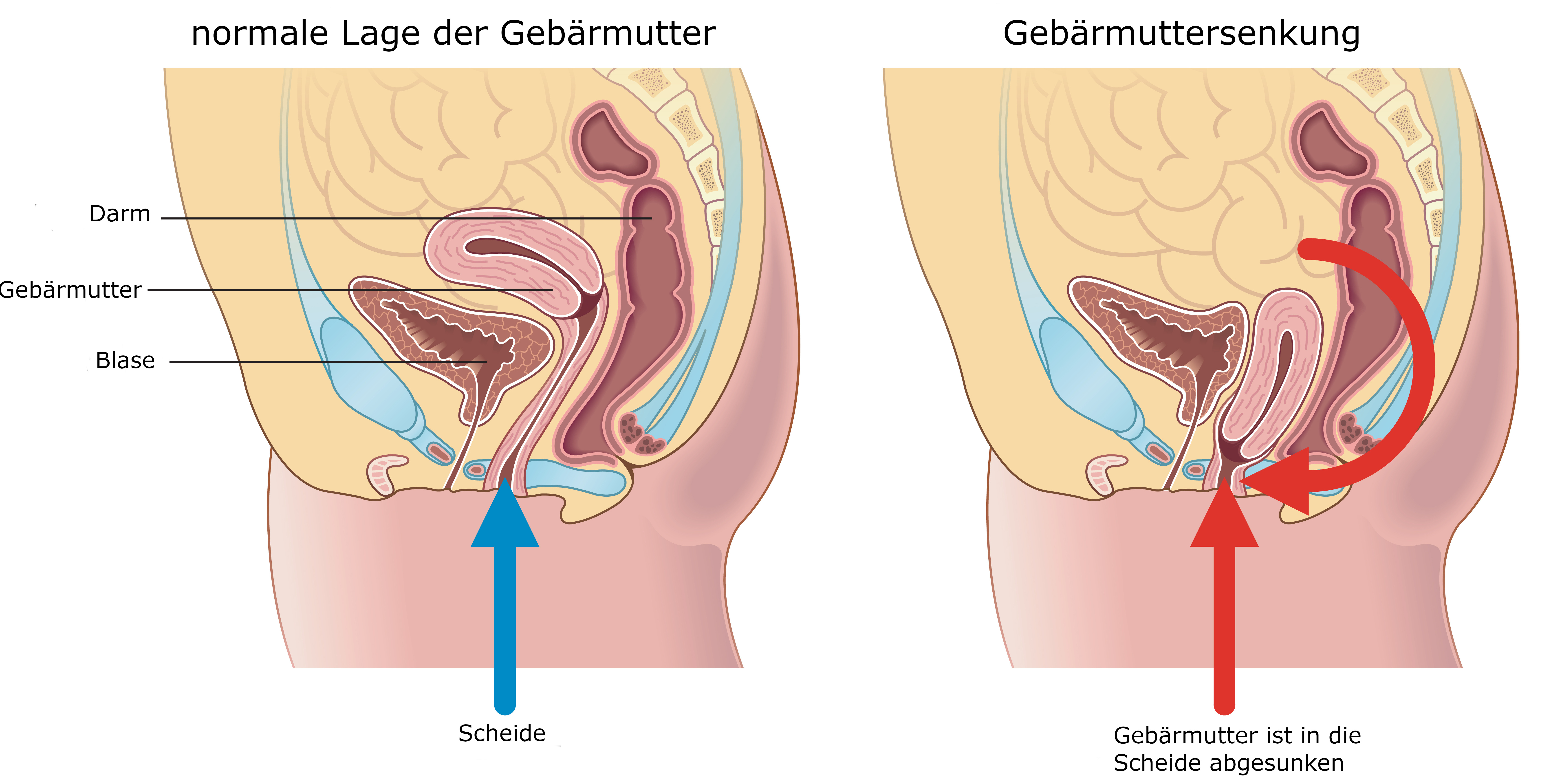 Grafik Gebärmuttersenkung