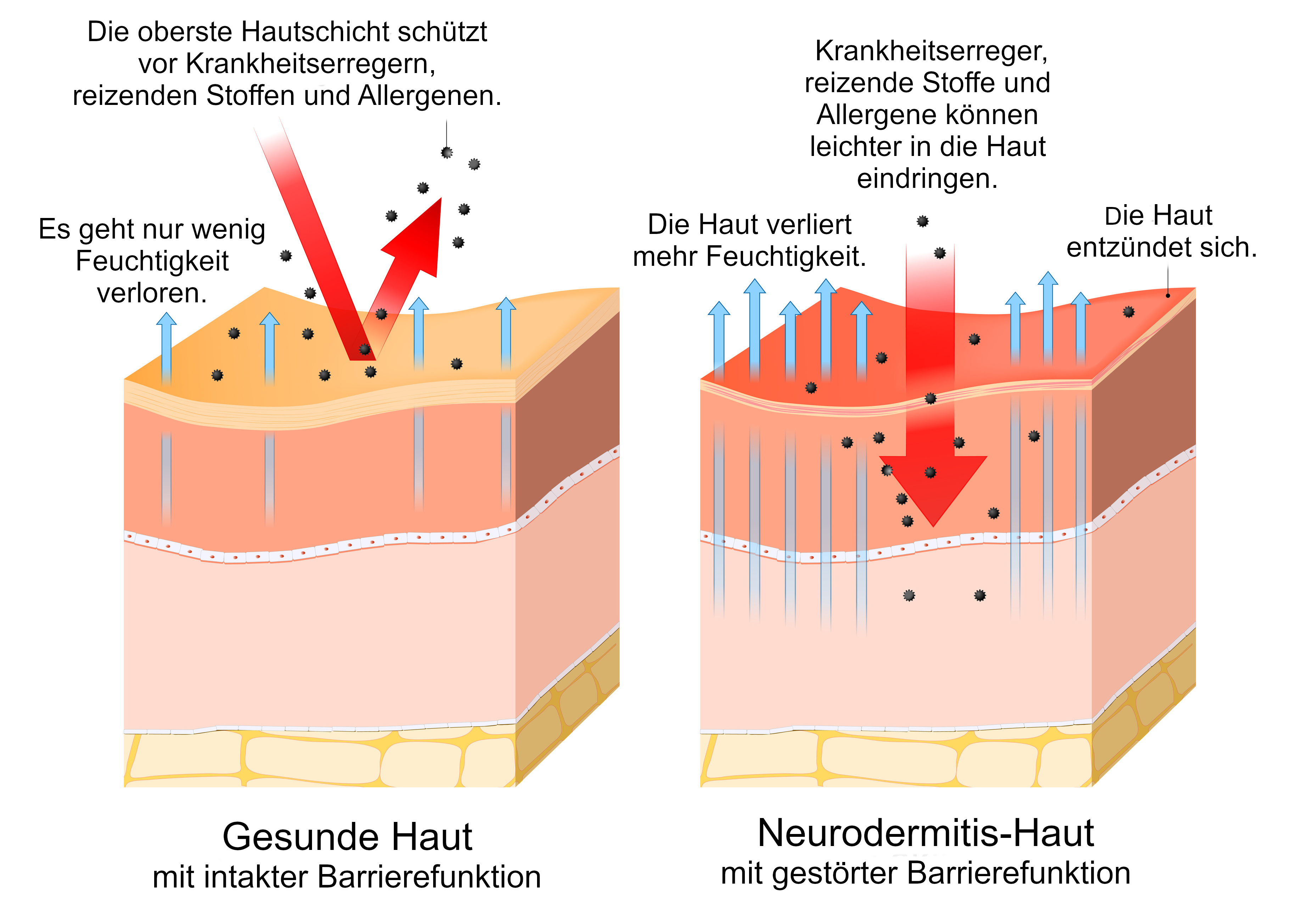 Grafik Neurodermitis