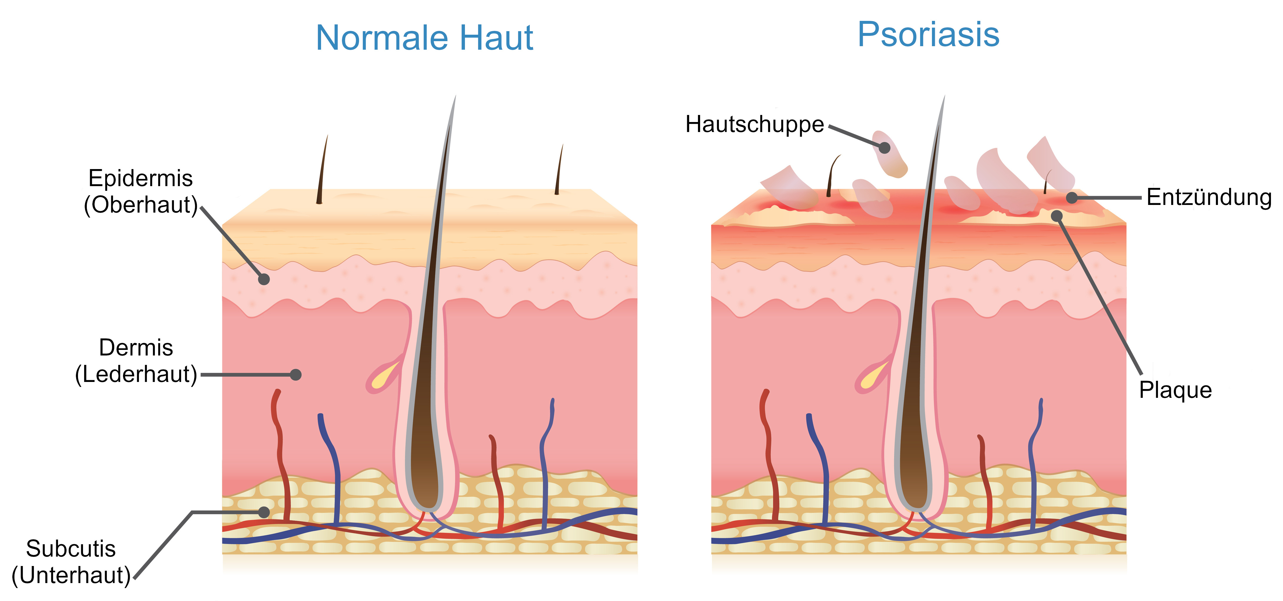 Grafik Psoriasis Hautveränderungen