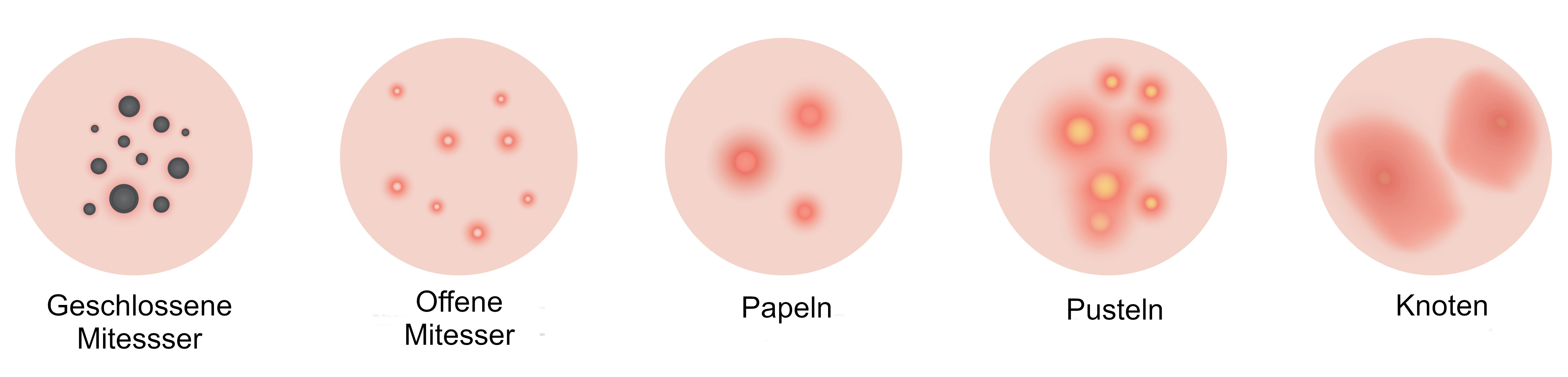 Grafik Akne Hautveränderungen