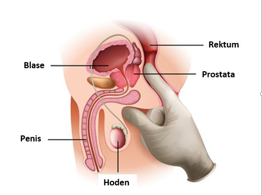 Symbolfoto für Prostatauntersuchung