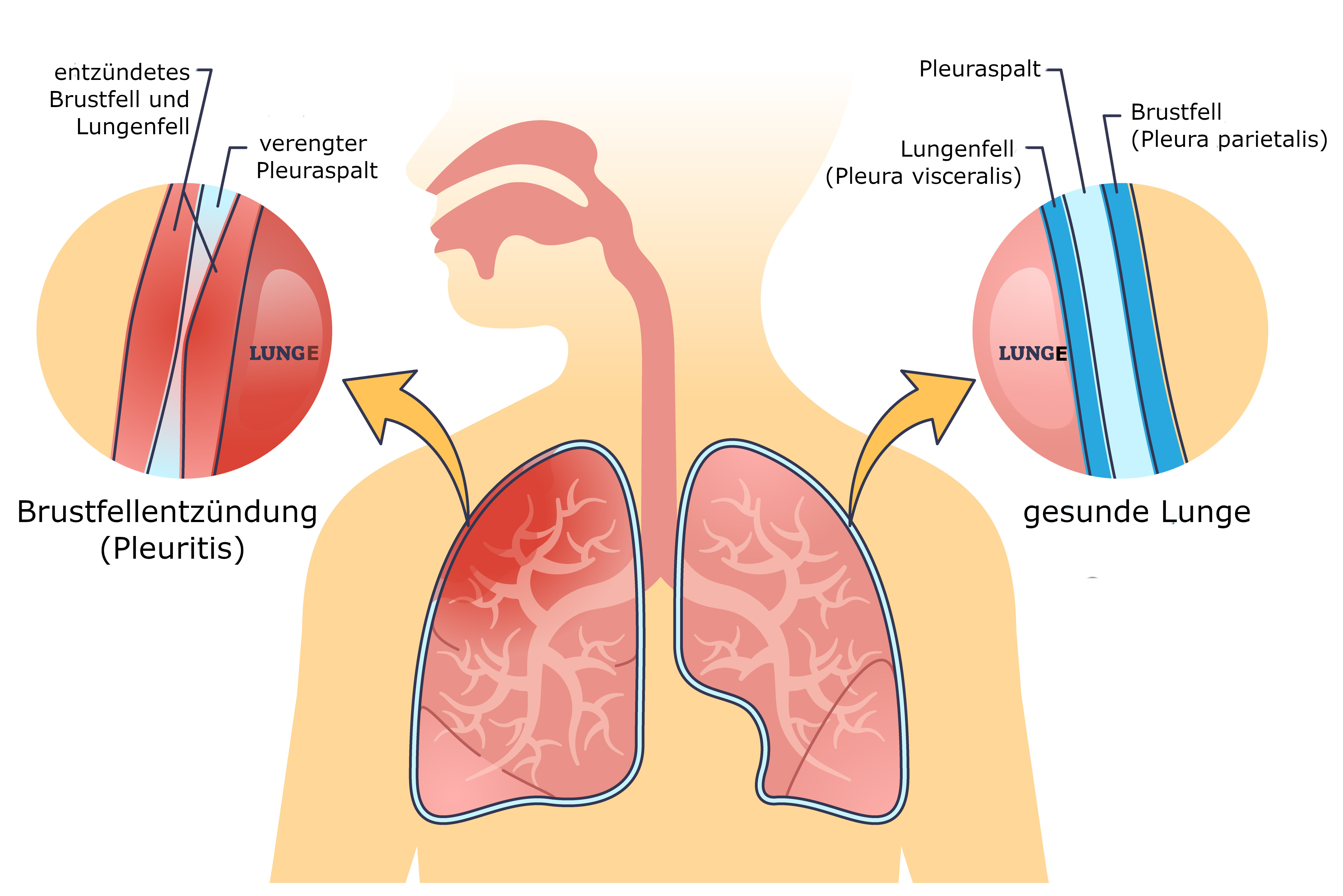 Grafik Pleuritis