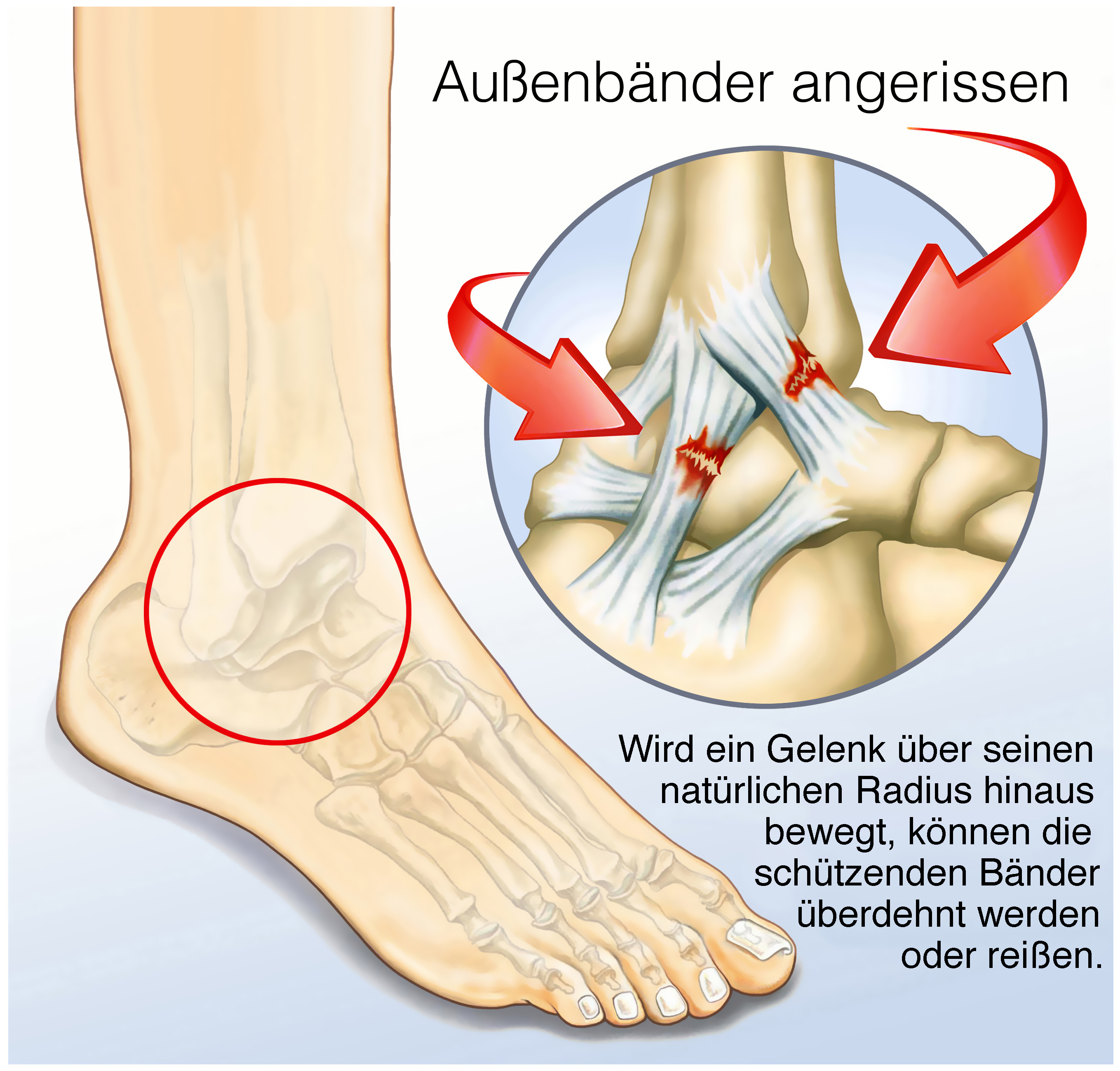 Grafik: Gerissene Bänder am Sprunggelenk