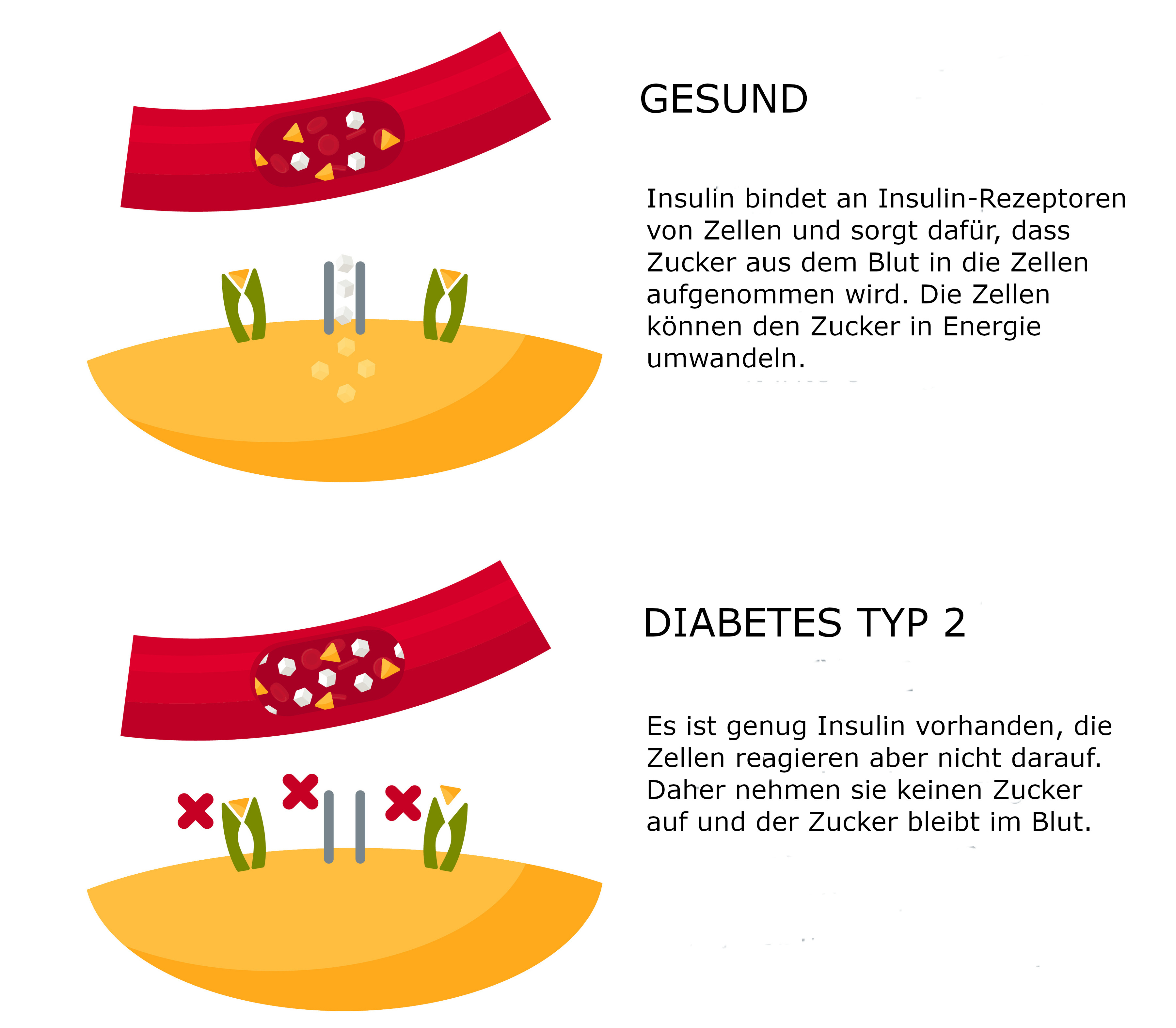 Grafik Diabetes Typ 2