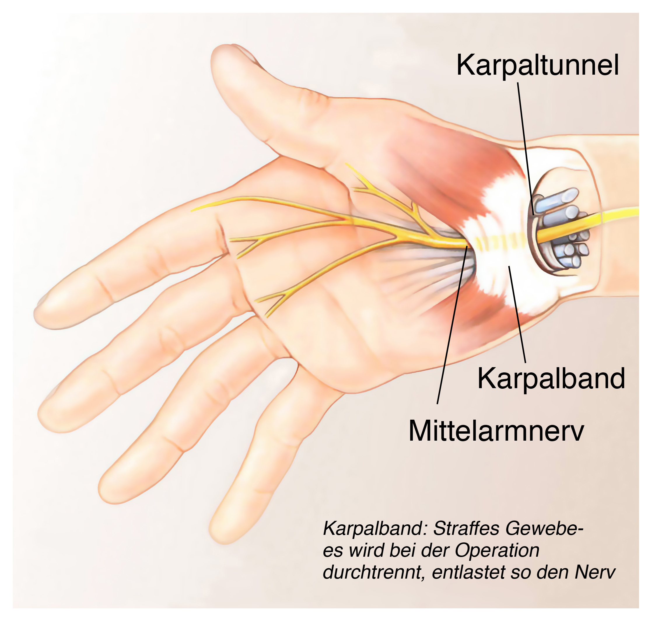 Grafik Karpalunnelsyndrom