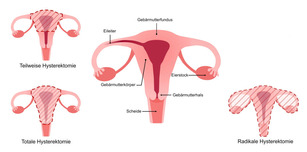 Grafik Gebärmutterentfernung