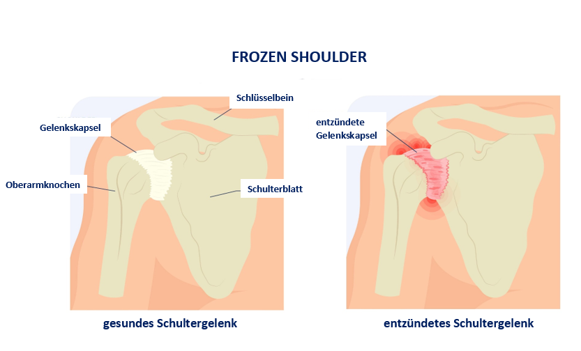 Symbolbild Frozen Shoulder