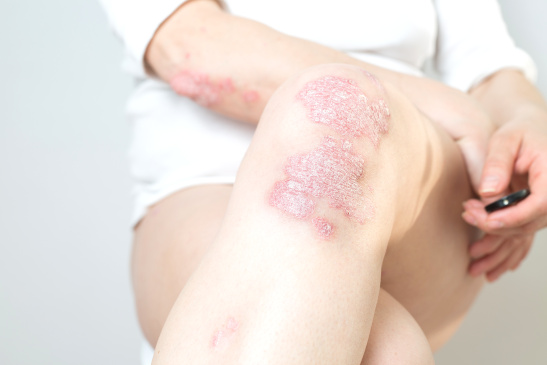 Beine einer Frau mit Psoriasis