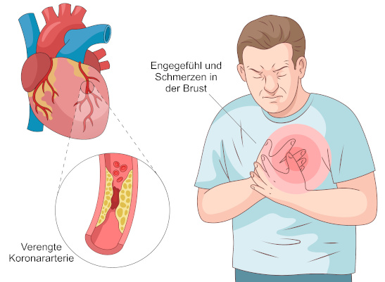 Grafik Koronare Herzkrankheit, Angina pectoris