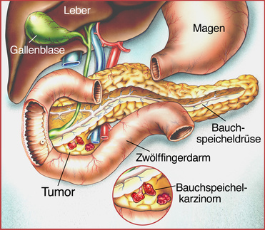 Bauchspeicheldrüsenkrebs