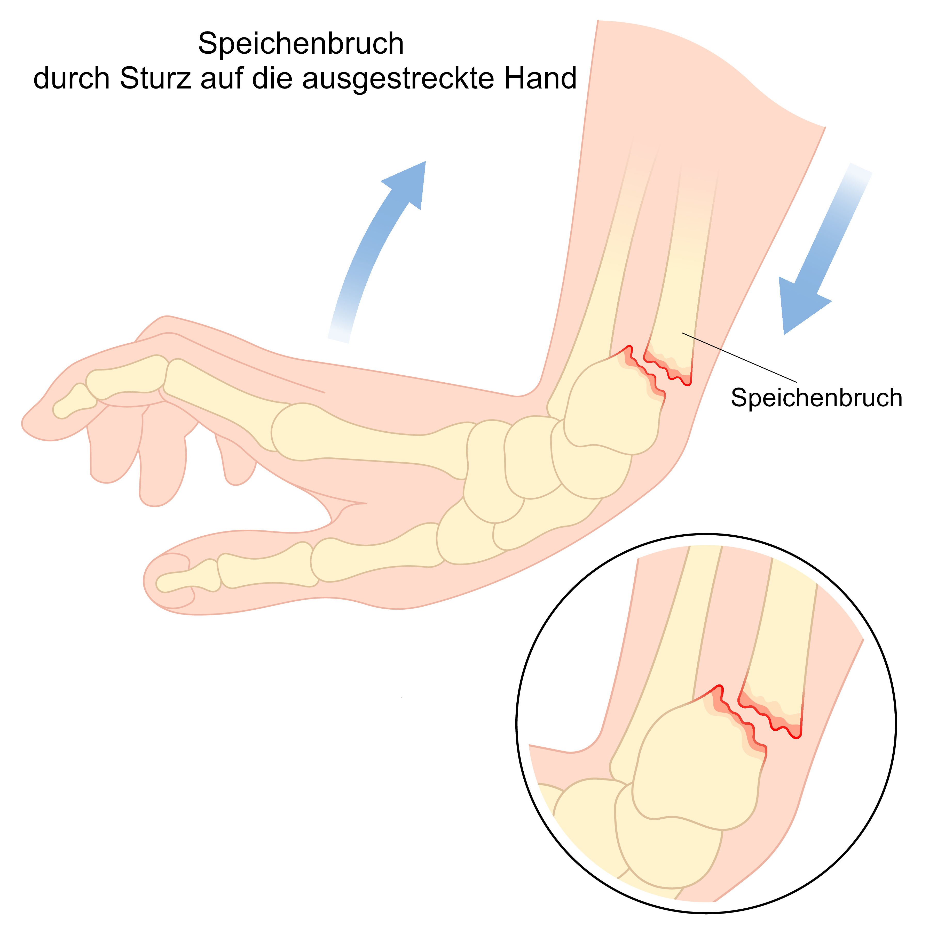 Grafik Speichenbruch