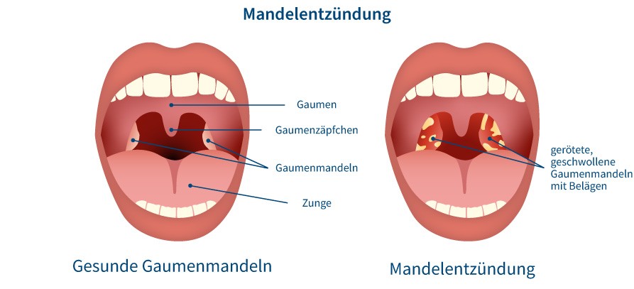 Grafik Unterschied gesunde Mandeln und Mandelentzündung
