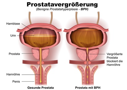 Prostatavergrößerung Illustration