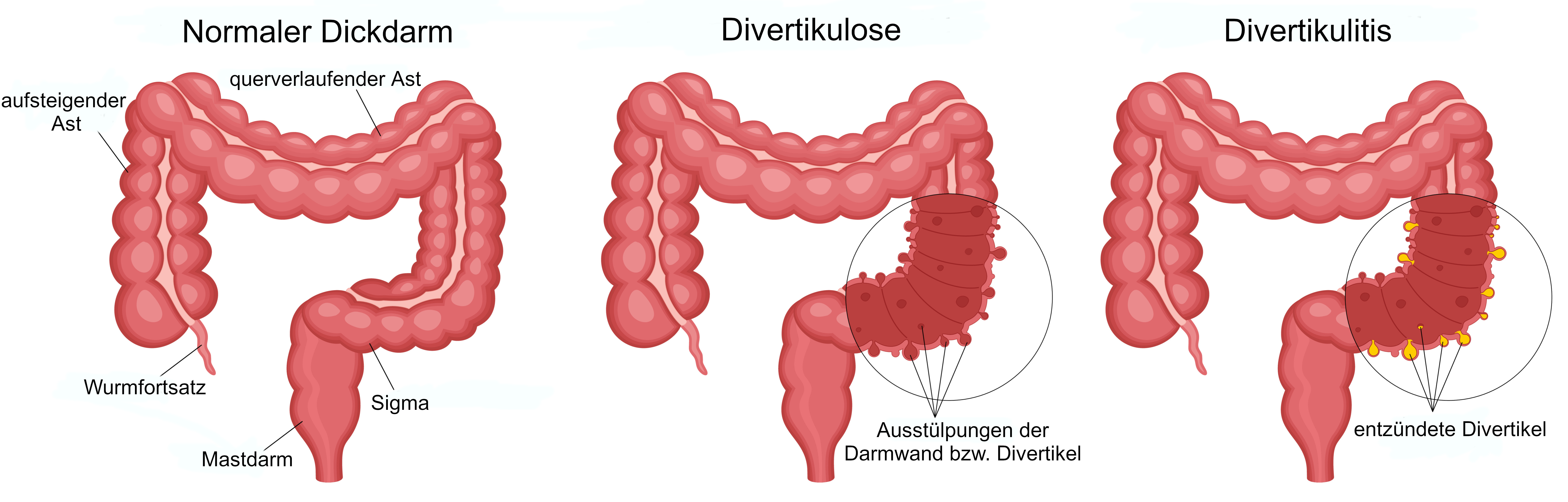 Grafik Divertikel Divertikulitis