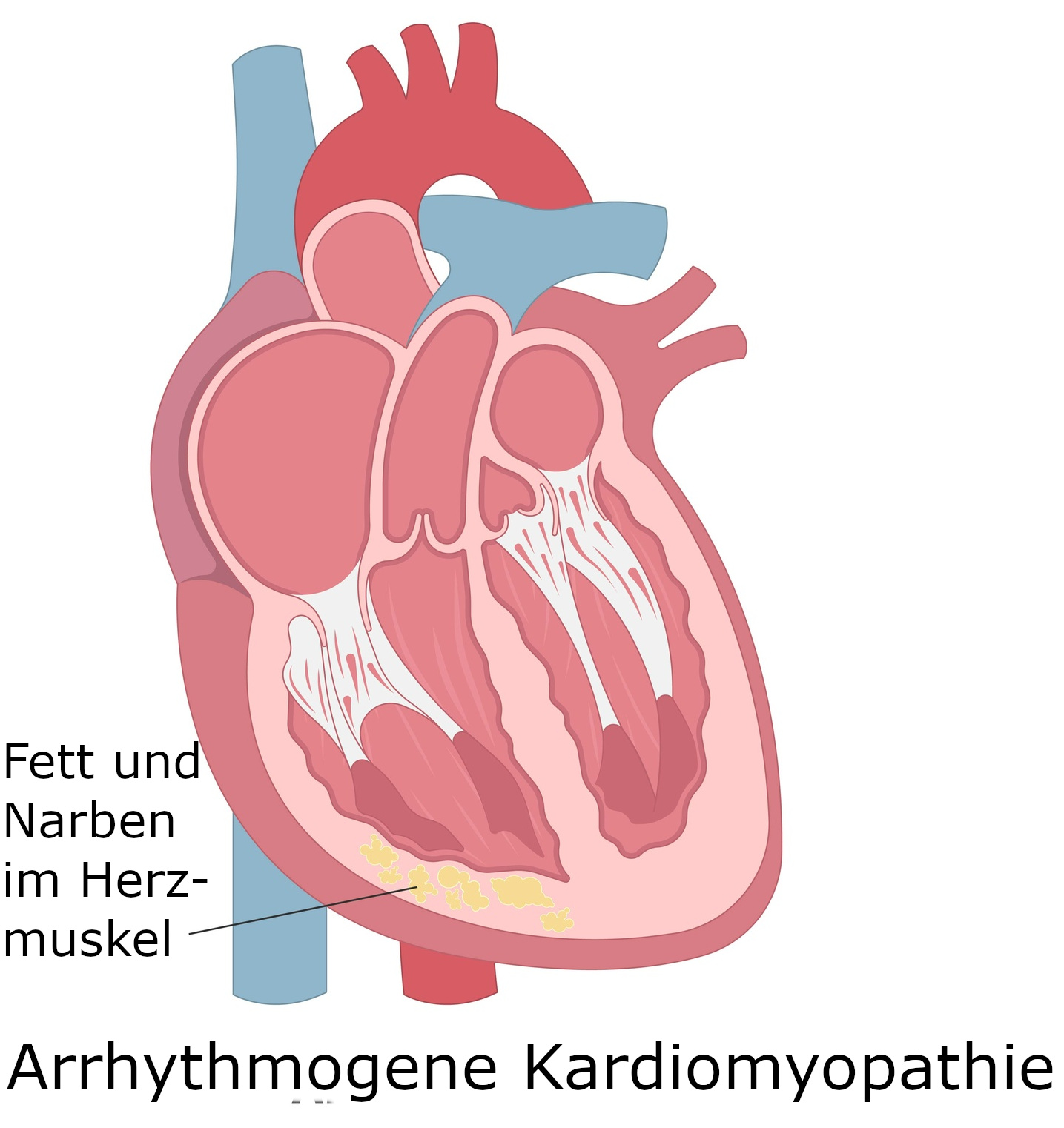 Grafik Arryhthmogene Herzmuskelerkrankung