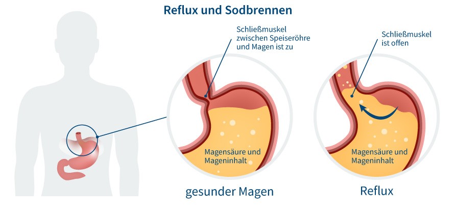 Grafik Sodbrennen und Reflux