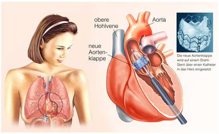Symbolfoto für Herz mit Stent