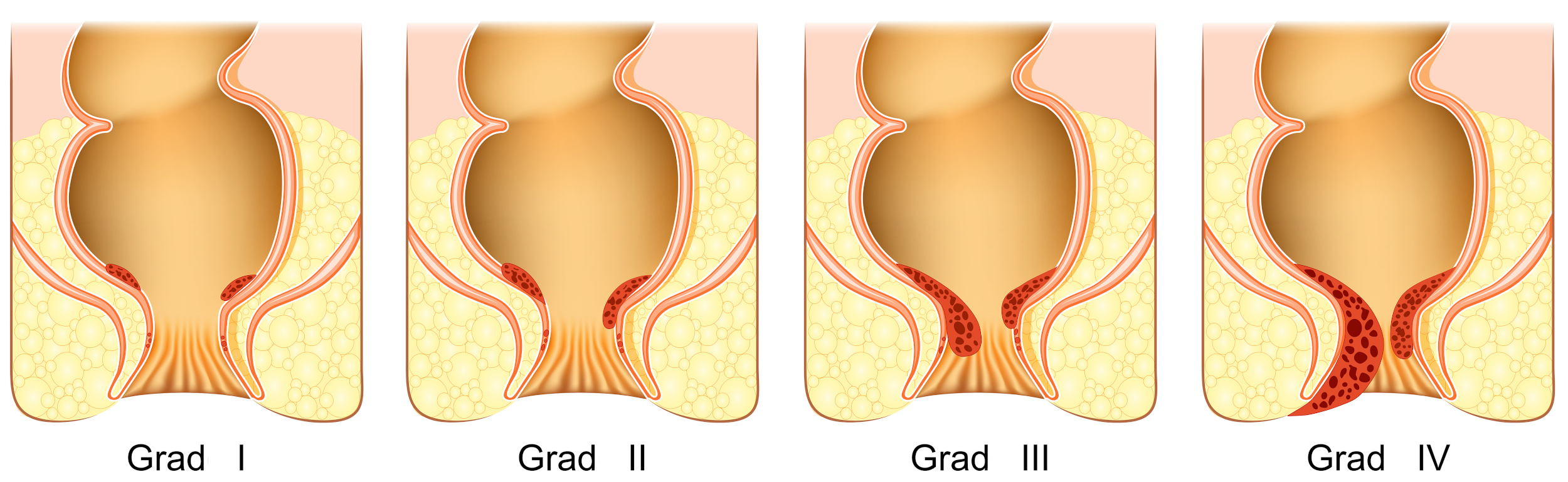 Grafik Hämorrhoiden Schweregrade