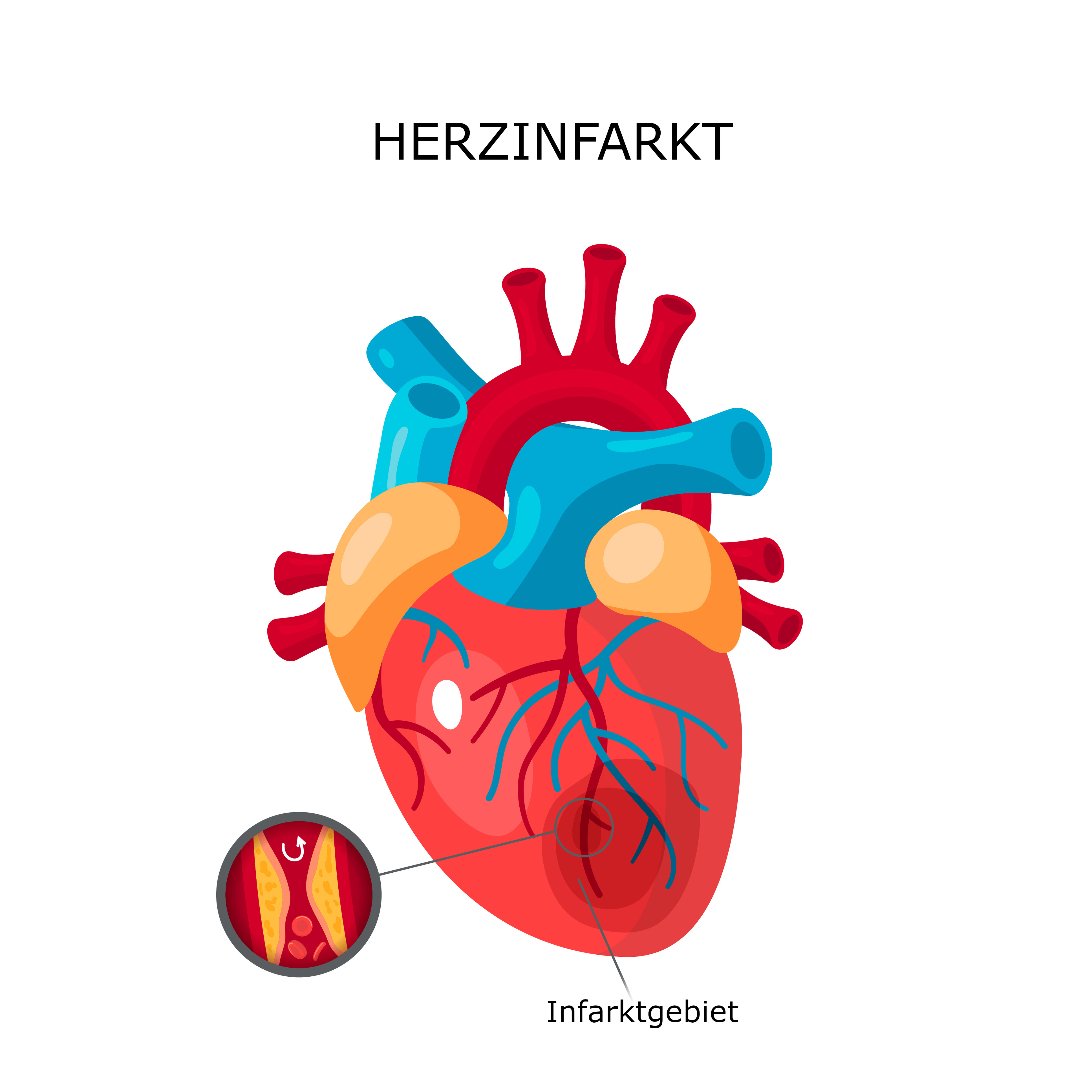 Symbolbild Herzinfarkt