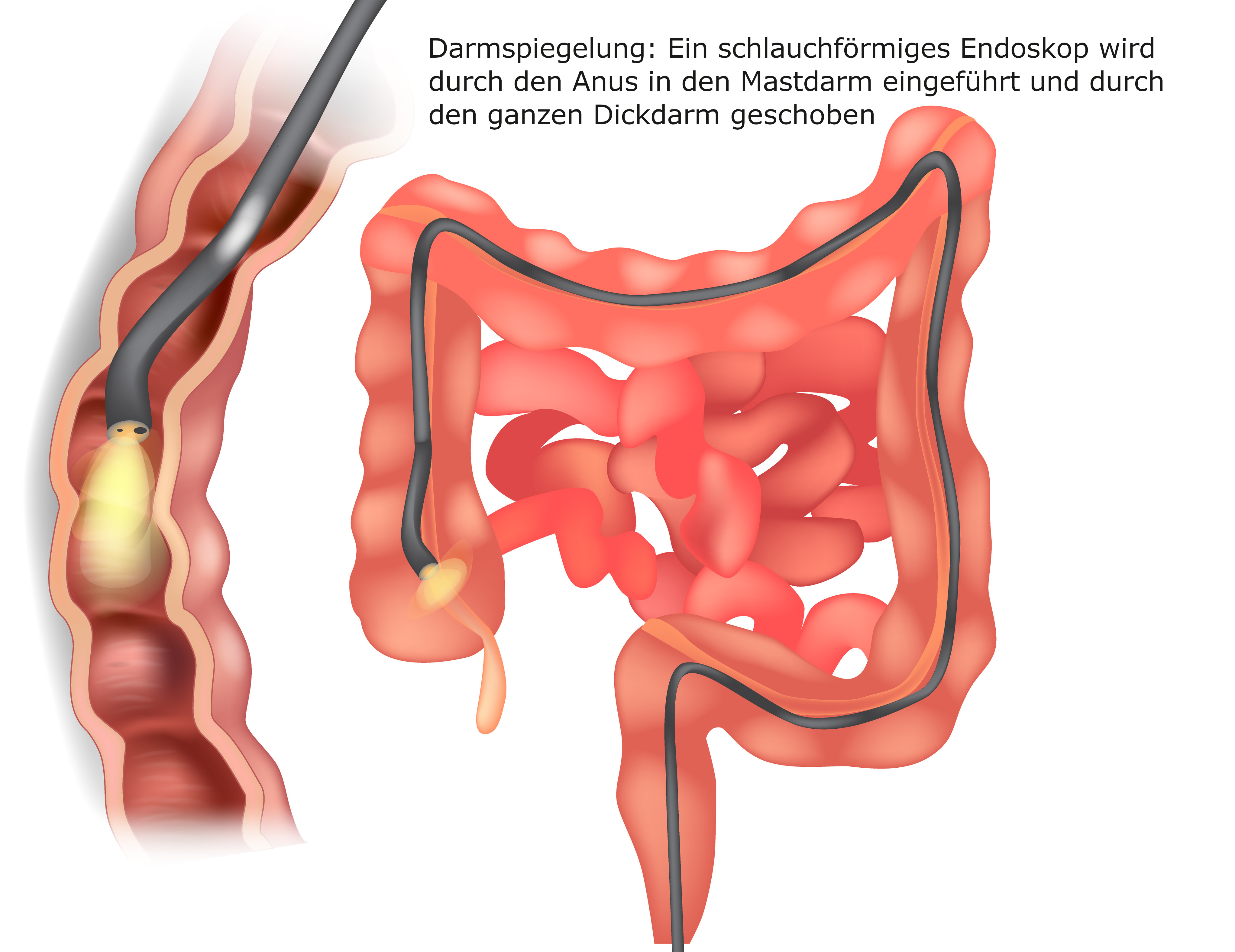 Grafik Koloskopie