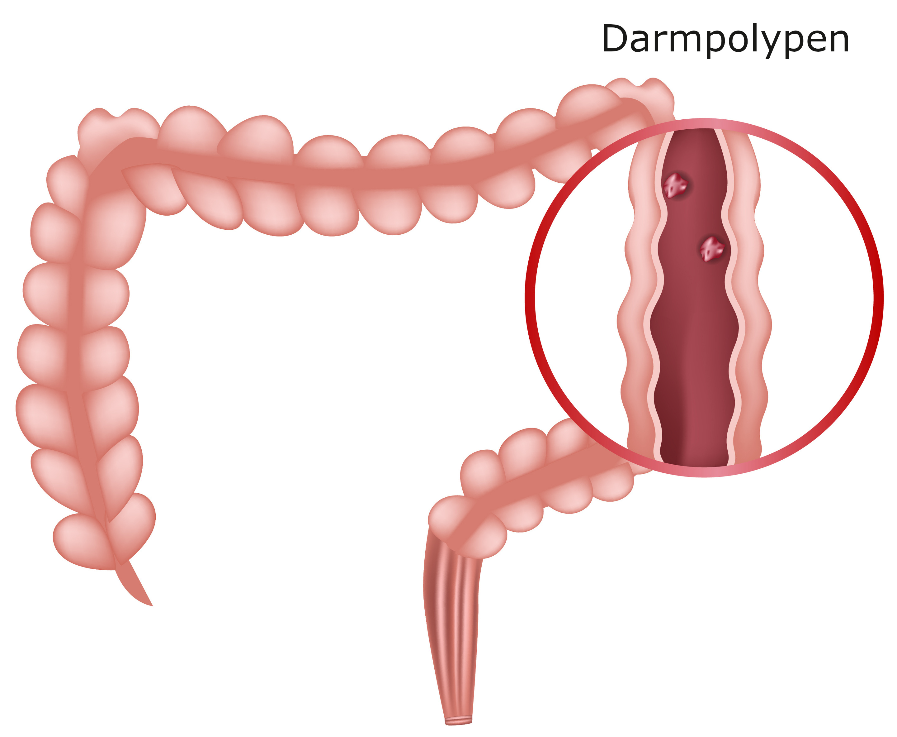 Grafik Darmpolyp