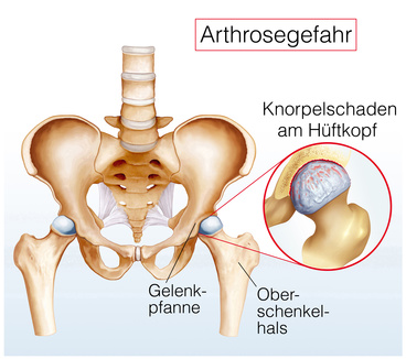 Knorpelschaden im Hüftgelenk