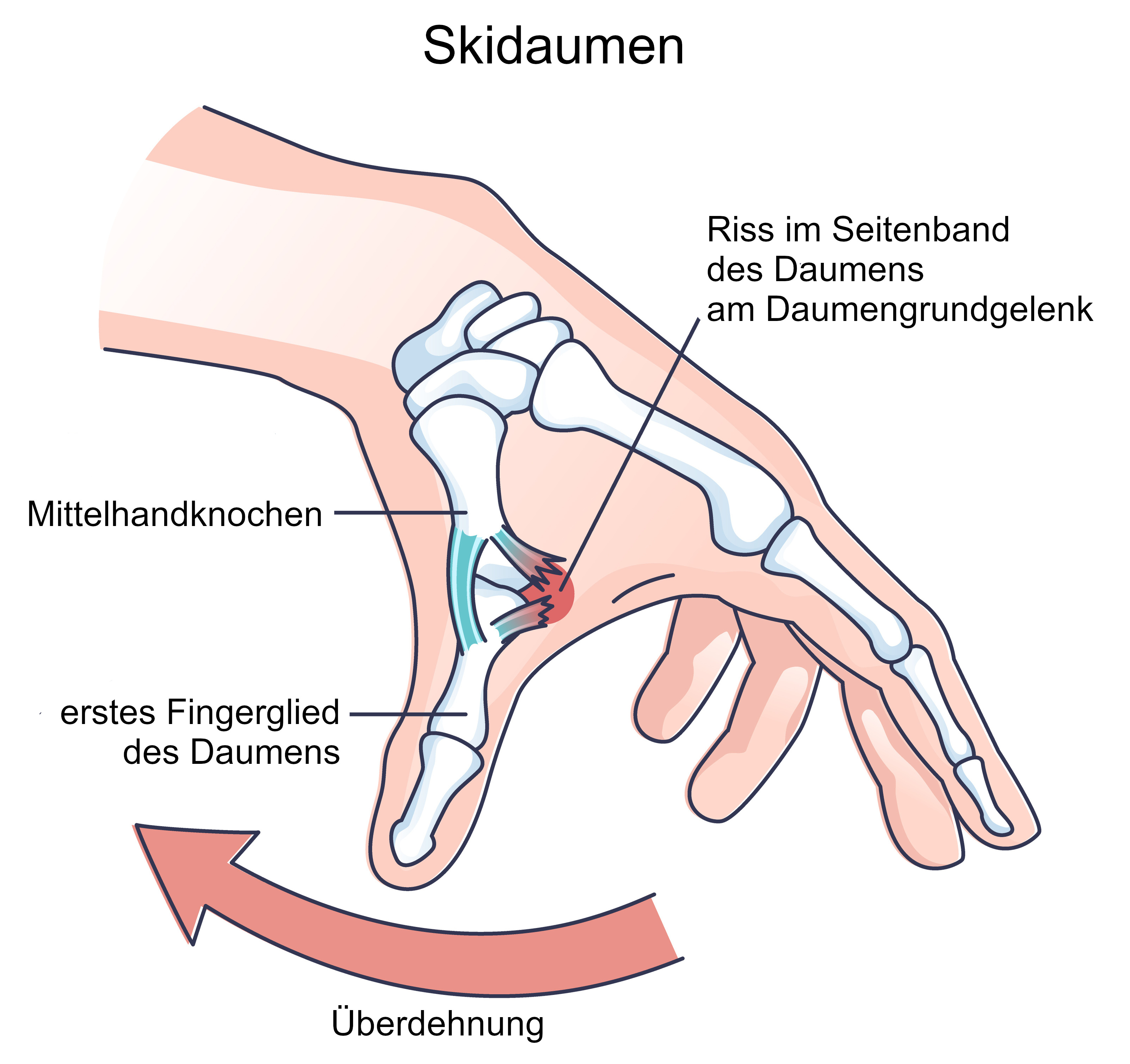 Grafik Skidaumen
