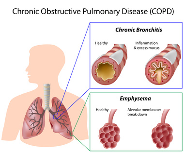 Grafik COPD