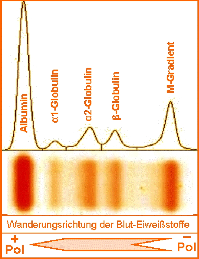 Ein M-Gradient ist eine schmale Bande im Bereich der Gamma-Glubulinfraktion der Serumeiweiß-Elektrophorese