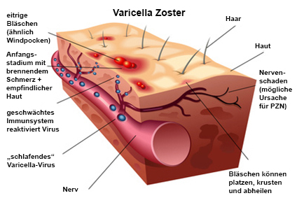 Varicella Zoster