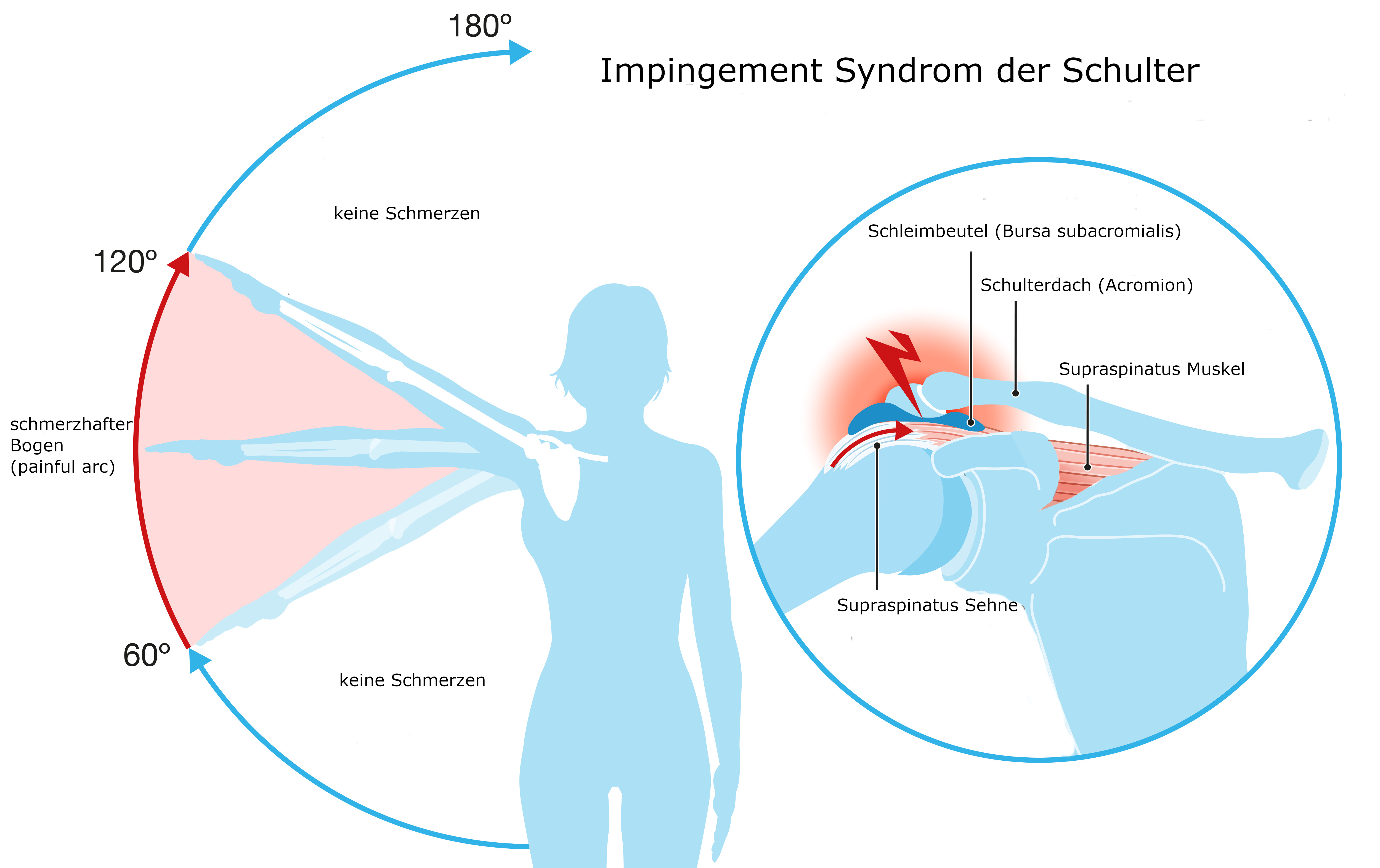 Grafik Impingement-Syndrom