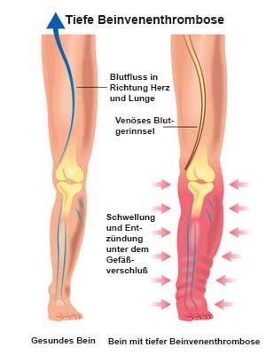 Tiefe Beinvenenthrombose