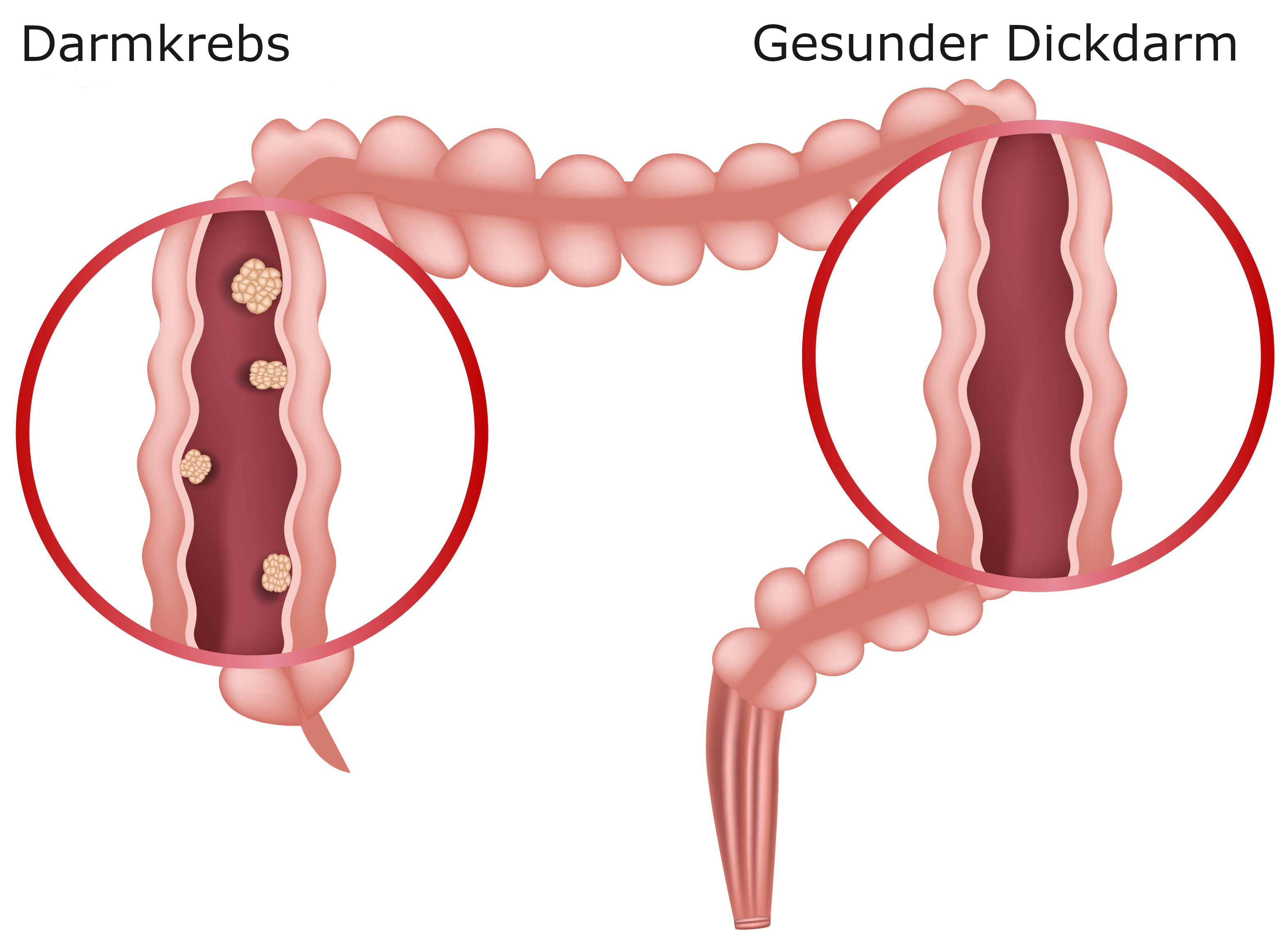 Grafik Darmkrebs