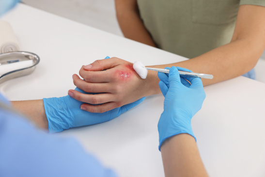 Verbrennung wird ärztlich behandelt