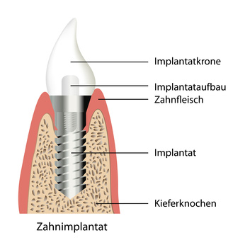 Symbolfoto für Implantatkrone
