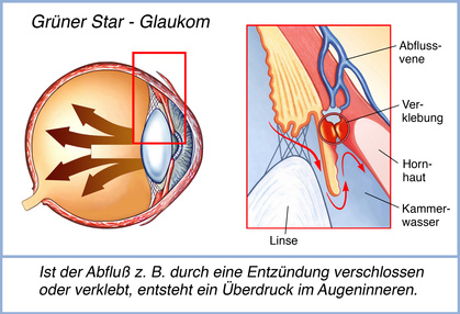 Grafik Glaukom