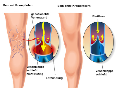 Krampfadern