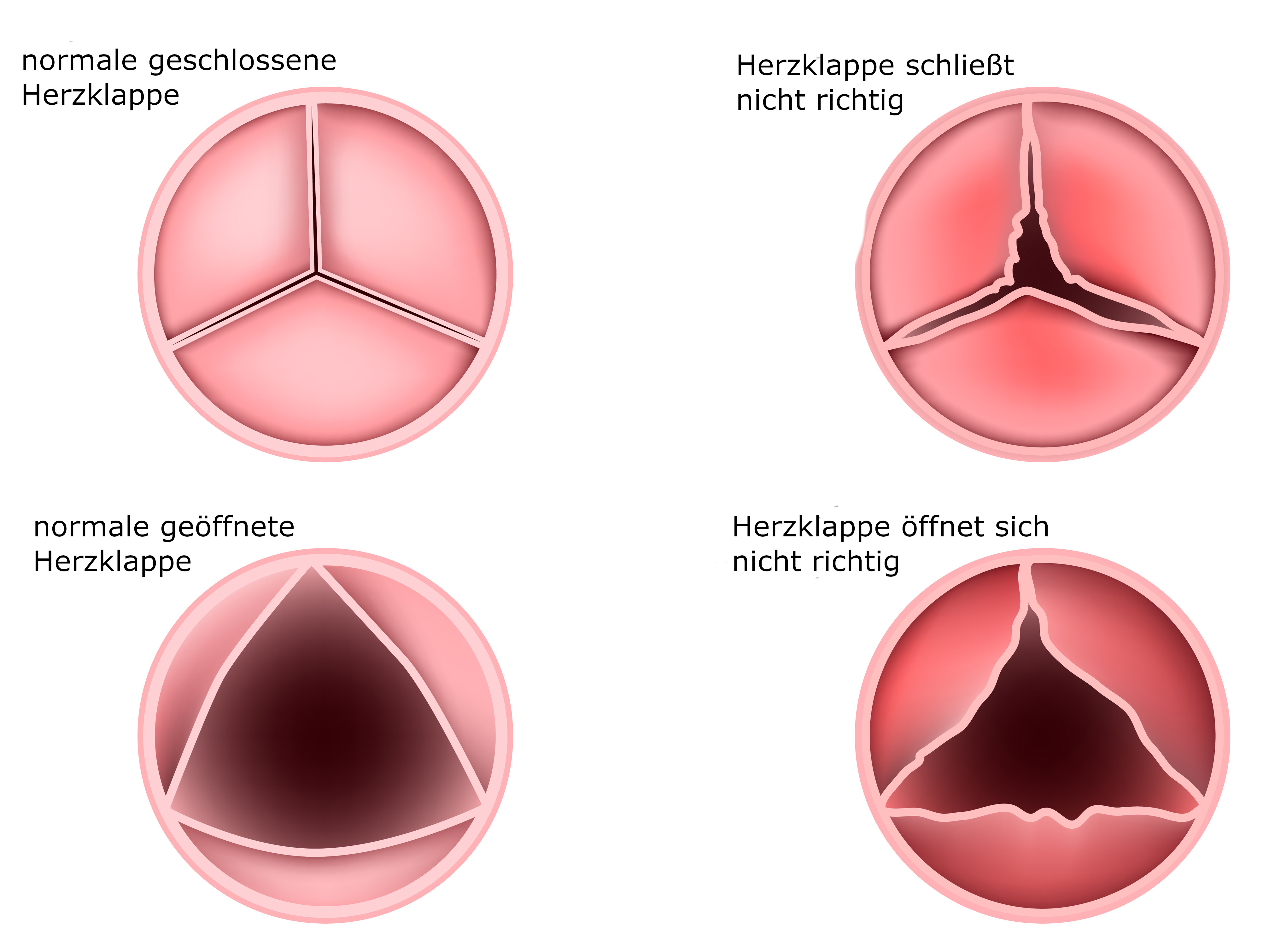 Grafik Herzklappenfehler