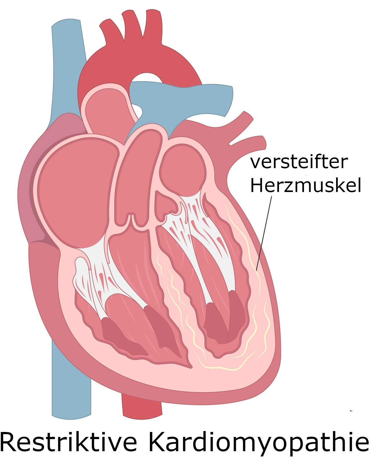 Grafik Restriktive Herzmuskelerkrankung