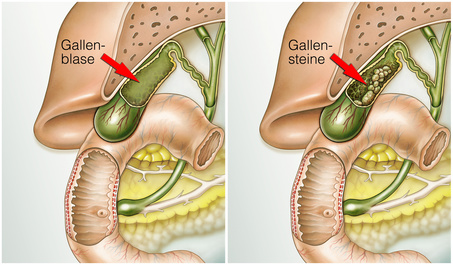 Gallensteine Symptome