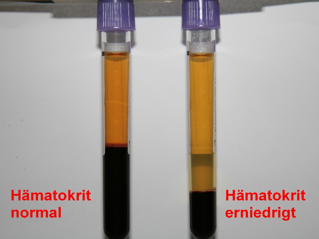 Der Hämatokrit-Wert ist der prozentuelle Anteil der roten Blutkörperchen am gesamten Blutvolumen