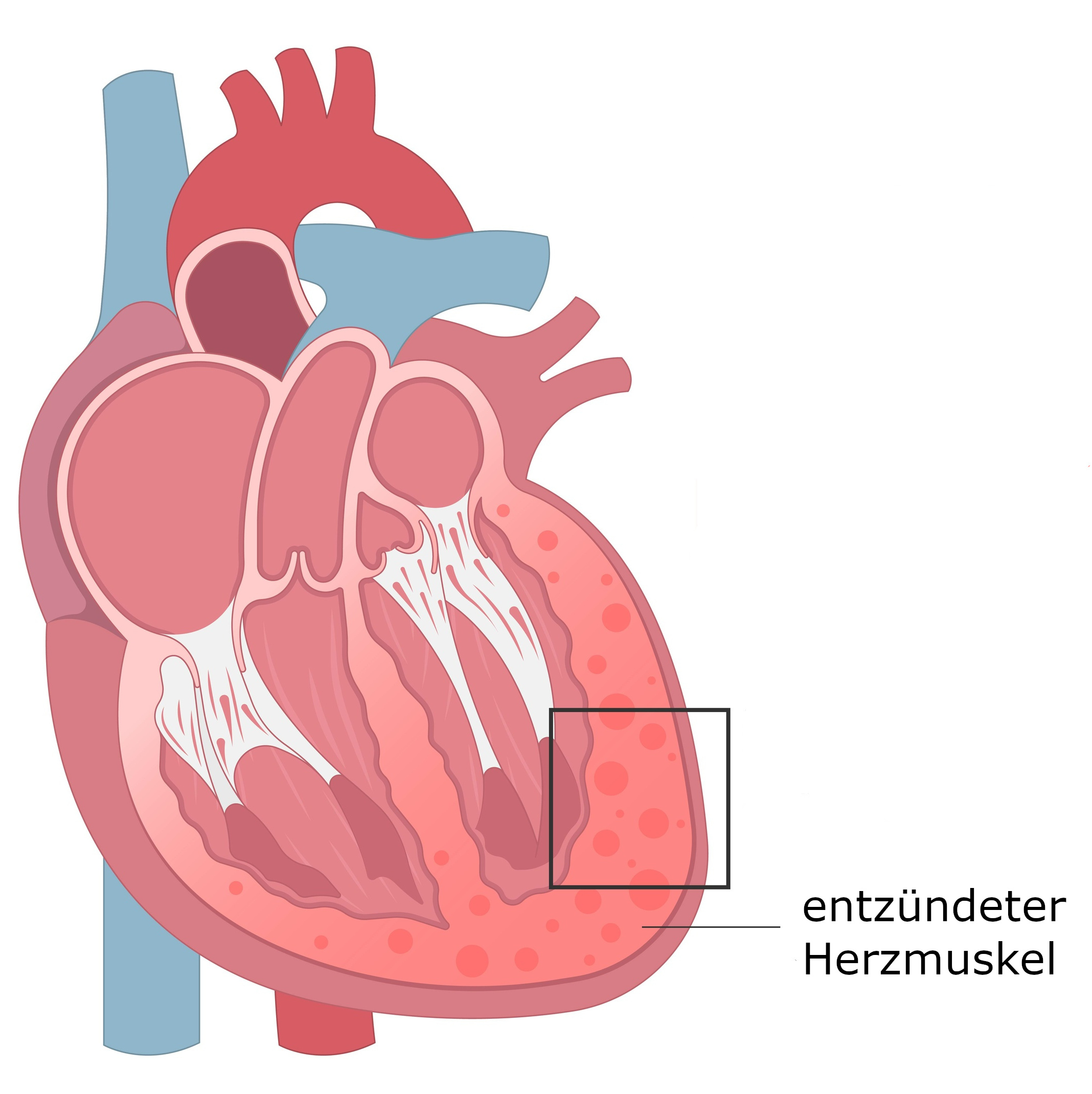 Grafik Herzmuskelentzündung