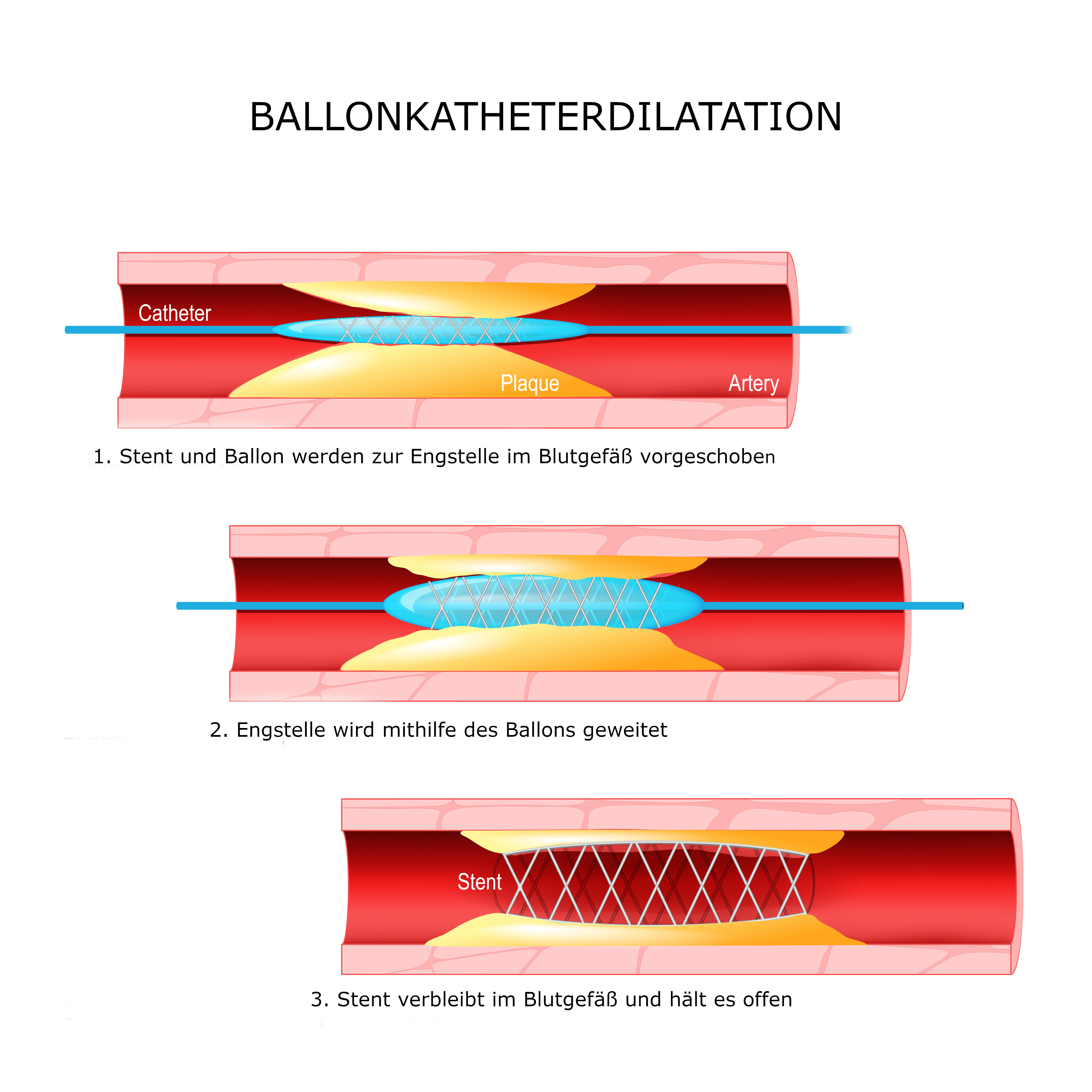 Schema Ballonkatheterdilatation