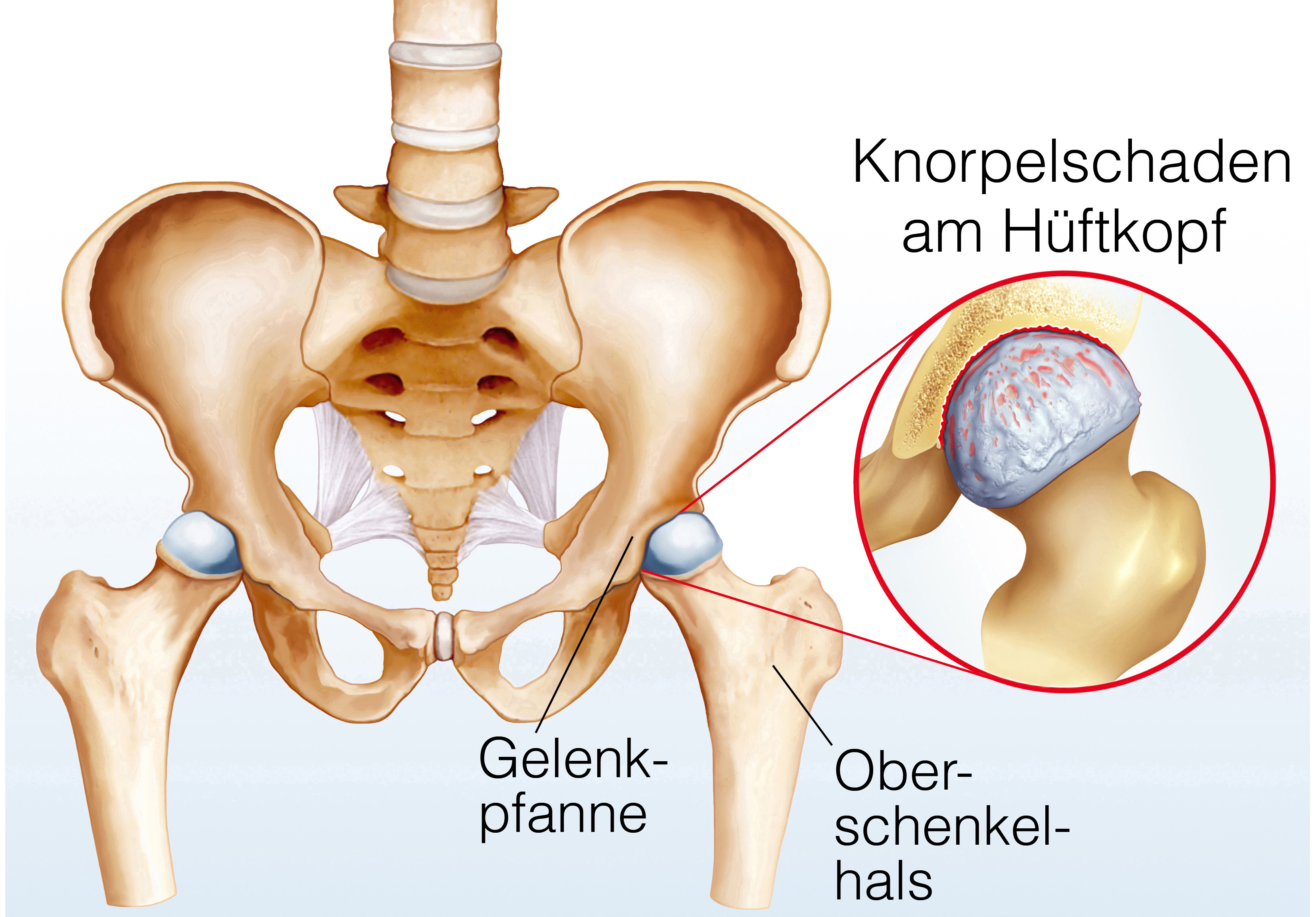 Grafik Hüftarthrose