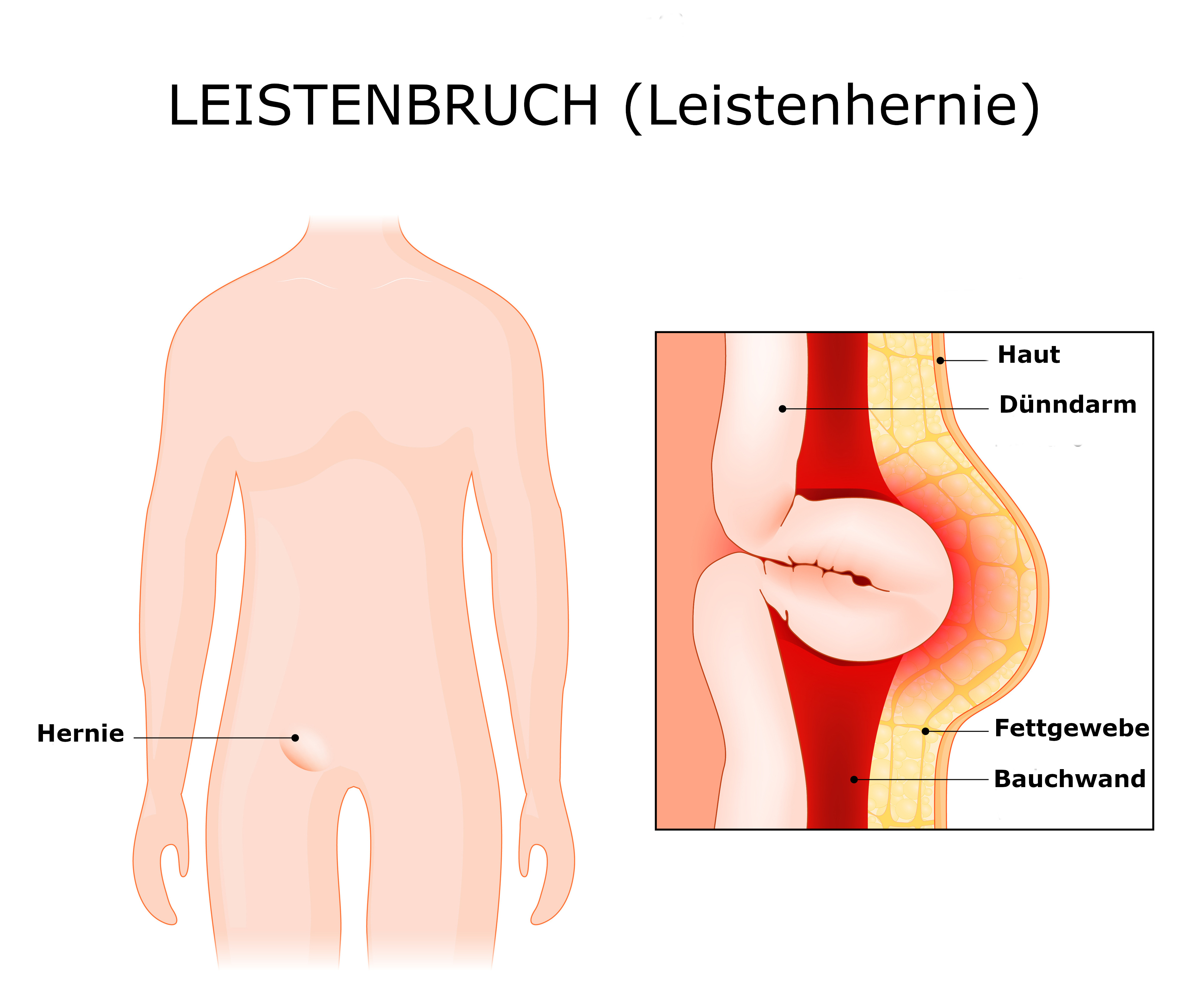 Leiste: Anatomie der Inguinalregion